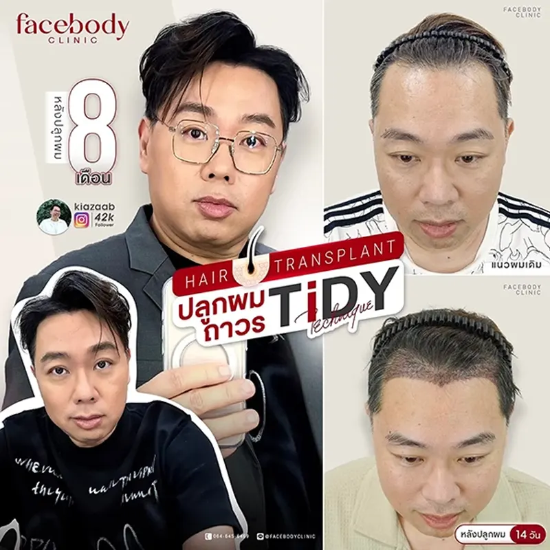 รีวิวปลูกผม Long Hair FUE Facebody Clinic