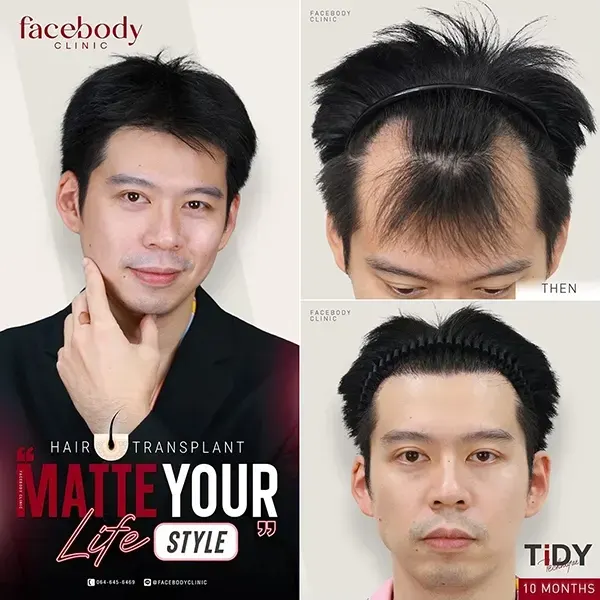 รีวิวปลูกผมถาวร FUE โดยแพทย์ American Board