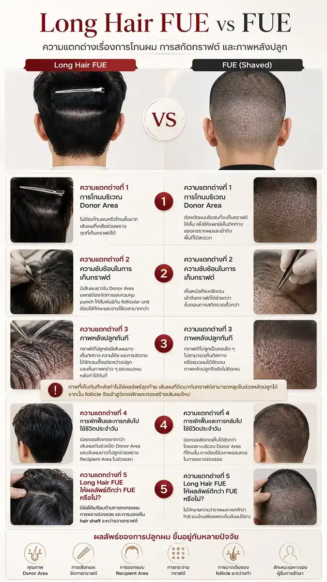 Long Hair FUE vs FUE ต่างกันตรงไหน? ความแตกต่างที่คนไข้เห็นชัดที่สุดคือ เรื่องการโกนผม แต่ในมุมของแพทย์ยังมีรายละเอียดเรื่องการเข้าถึง Donor Area การสกัดกราฟต์ และการจัดการเส้นผมที่ต่างกัน