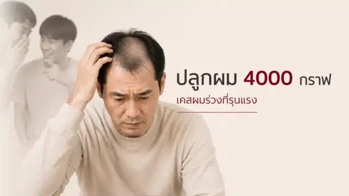 ปลูกผม 4000 กราฟ เคสที่มีพื้นที่เยอะ hair-transplant-4000-grafts-cost