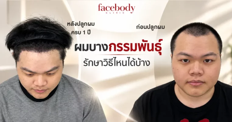 1_ Year_Hair_Transplant_Review