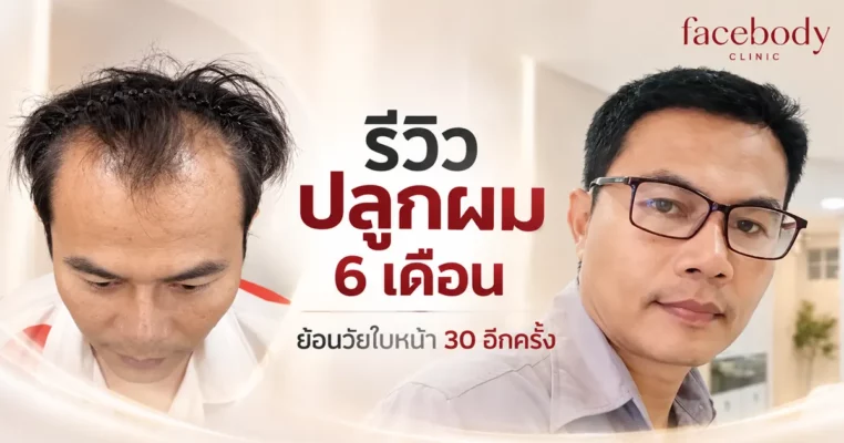 6-Month Hair Transplant Review Turning Back the Clock to 30 Again