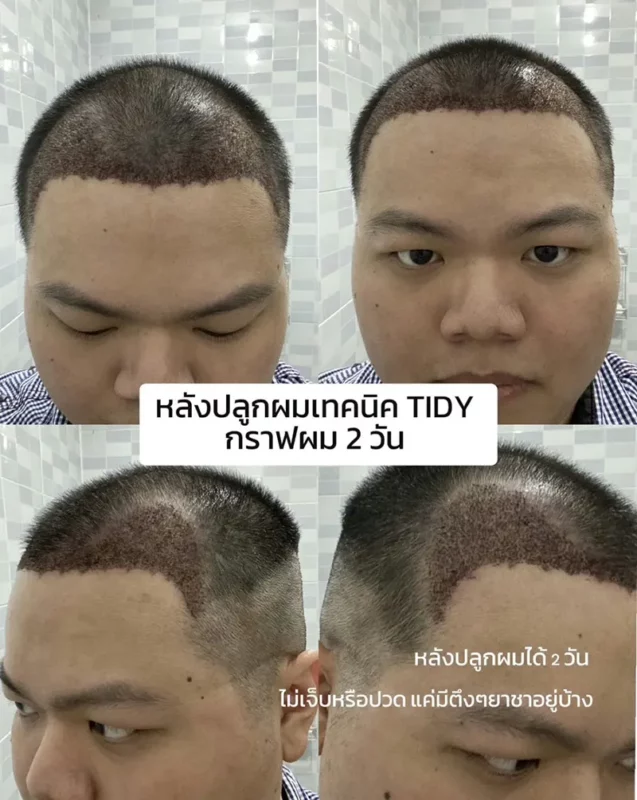 รีวิวปลูกผม ผมบางจากกกรรมพันธุ์