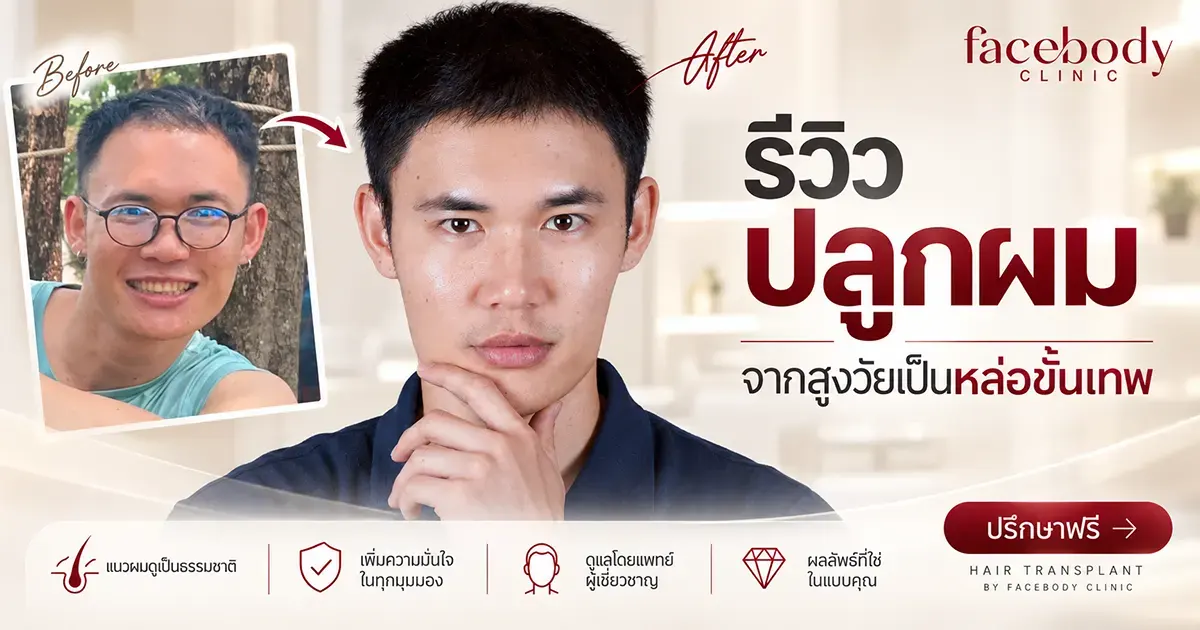 รีวิวปลูกผม 1 ปี กว่า เปลี่ยนแปลงอย่างไร? เมื่อเปรียบเทียบกับก่อนปลูกผม สิ่งที่รู้สึกได้ชัดเจนไม่ได้มีเพียงเรื่องของเส้นผม แต่คือ “ความมั่นใจ” ที่กลับมา