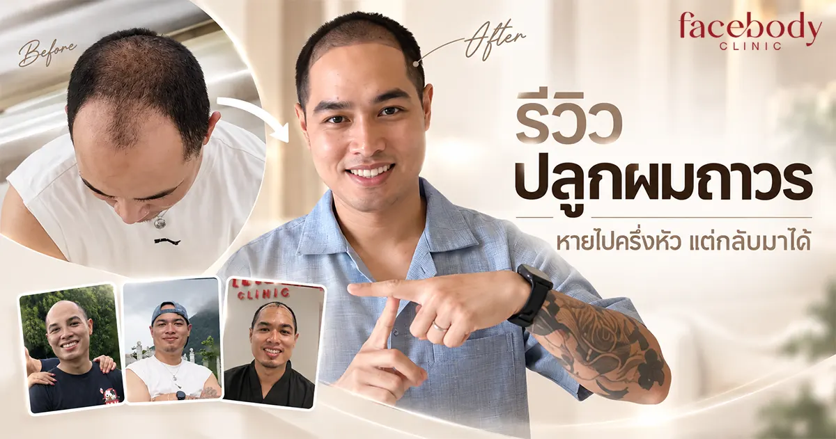 รีวิวปลูกผมถาวร คุณมีน-วิศวกรเครื่องบิน