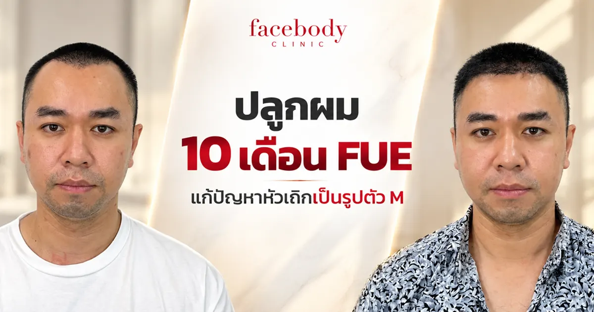 ปลูกผม 10 เดือน ผลลัพธ์เป็นอย่างไร? สำหรับเคสคุณเอ็ม ซึ่งมีปัญหาผมด้านหน้าถอยร่นเป็นรูปตัวเอ็มตั้งแต่อายุ 20 ต้น ๆ หลังปลูกผมด้วยเทคนิค FUE และติดตามผลครบ 10 เดือน พบว่าแนวผมบริเวณที่ปลูกดูหนาแน่นขึ้นอย่างชัดเจน