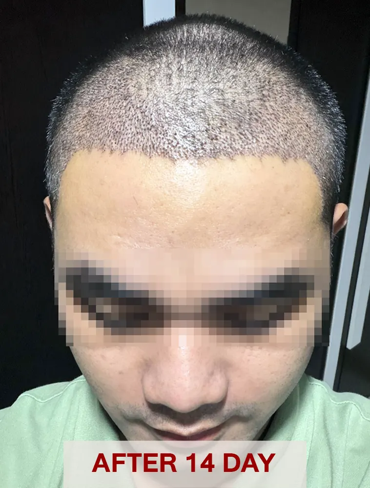 14-Day-graft-anchoring-in-hair-transplantation