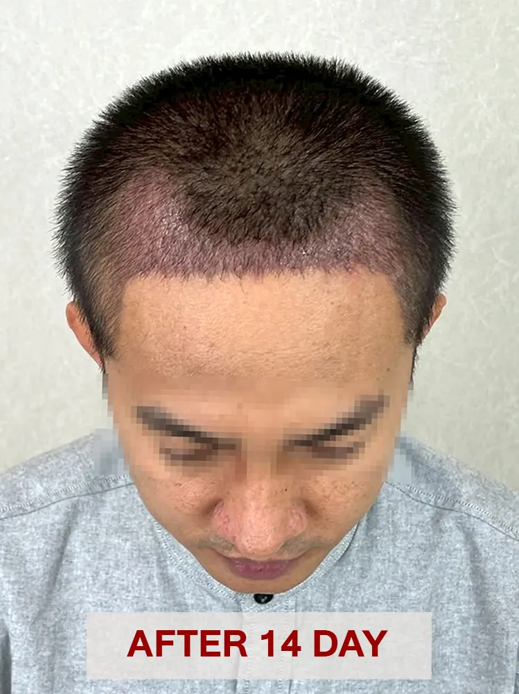 ในช่วงวันแรกหลังปลูก กราฟต์ยังต้องใช้เวลาในการยึดเกาะกับเนื้อเยื่อรอบข้าง จึงจำเป็นต้องระวังการสัมผัสและแรงเสียดสีเป็นพิเศษ แต่เมื่อเวลาผ่านไป การยึดเกาะจะค่อย ๆ มั่นคงขึ้น