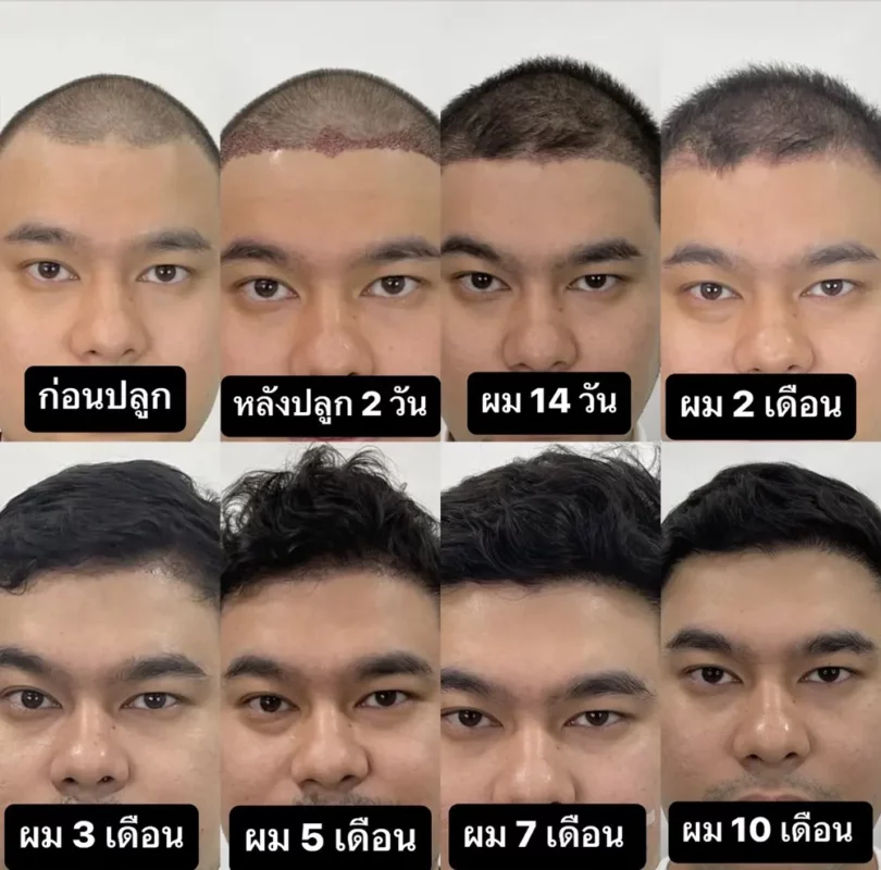 หลังจากผ่านช่วงเดือนที่ 4 ไปแล้ว ผมเริ่มสังเกตเห็นความเปลี่ยนแปลงมากขึ้นเรื่อย ๆ ครับ โดยเฉพาะช่วงเดือนที่ 6–9 เส้นผมบริเวณที่ปลูกเริ่มยาวขึ้นและดูหนาแน่นกว่าเดิม จากที่เคยมองเห็นหนังศีรษะบริเวณด้านหน้าได้ค่อนข้างชัด ตอนนี้เริ่มมีเส้นผมขึ้นมาเติมบริเวณนั้นมากขึ้น