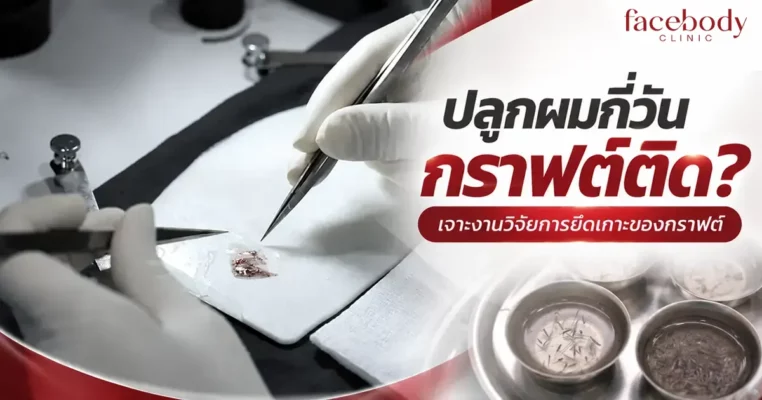 ารดึงเฉพาะเส้นผมไม่ทำให้กราฟต์หลุดตั้งแต่วันที่ 6 หลังปลูก ขณะที่การดึงสะเก็ดที่ติดแน่นกับหนังศีรษะยังมีความเสี่ยงถึงวันที่ 8 และไม่พบกราฟต์หลุดจากการทดสอบตั้งแต่วันที่ 9 เป็นต้นไป