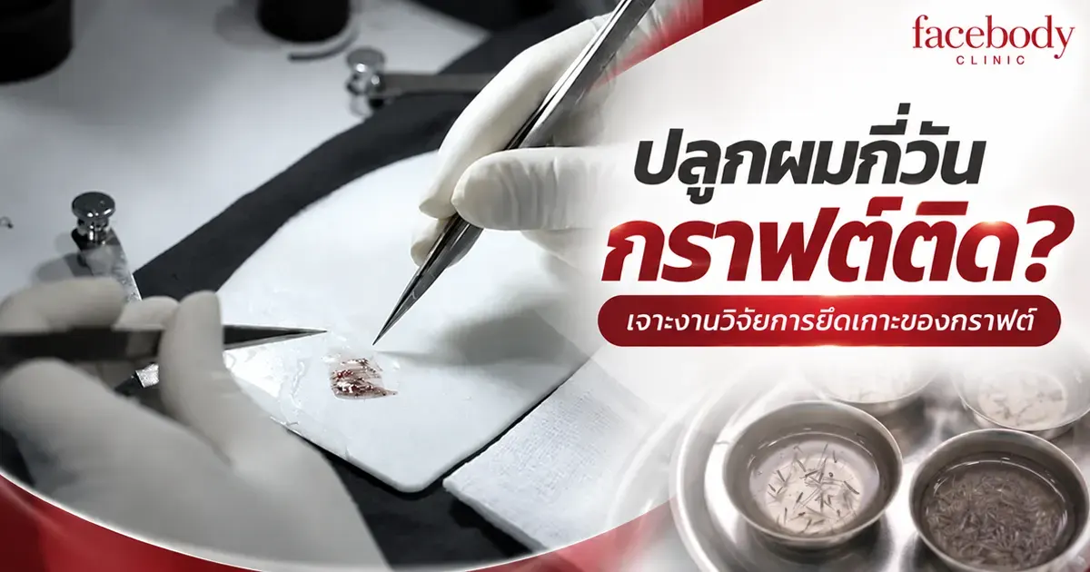 ารดึงเฉพาะเส้นผมไม่ทำให้กราฟต์หลุดตั้งแต่วันที่ 6 หลังปลูก ขณะที่การดึงสะเก็ดที่ติดแน่นกับหนังศีรษะยังมีความเสี่ยงถึงวันที่ 8 และไม่พบกราฟต์หลุดจากการทดสอบตั้งแต่วันที่ 9 เป็นต้นไป