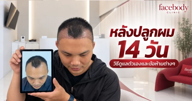 หลังปลูกผม 14 วัน สะเก็ดยังไม่หลุด ผิดปกติไหม? สะเก็ดแผลเป็นส่วนหนึ่งของกระบวนการสมานแผลหลังปลูกผม โดยมักค่อย ๆ หลุดออกในช่วงประมาณ 1–2 สัปดาห์แรก แต่บางคนอาจมีสะเก็ดหลงเหลือหลังครบ 14 วันได้