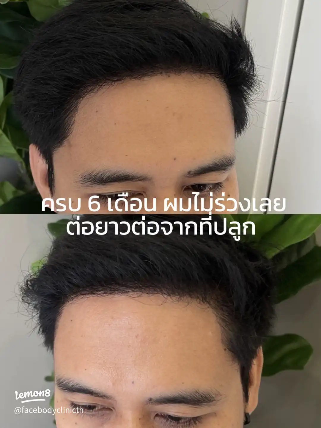 ผมขึ้นหลังปลูกผม 2500 กราฟต์