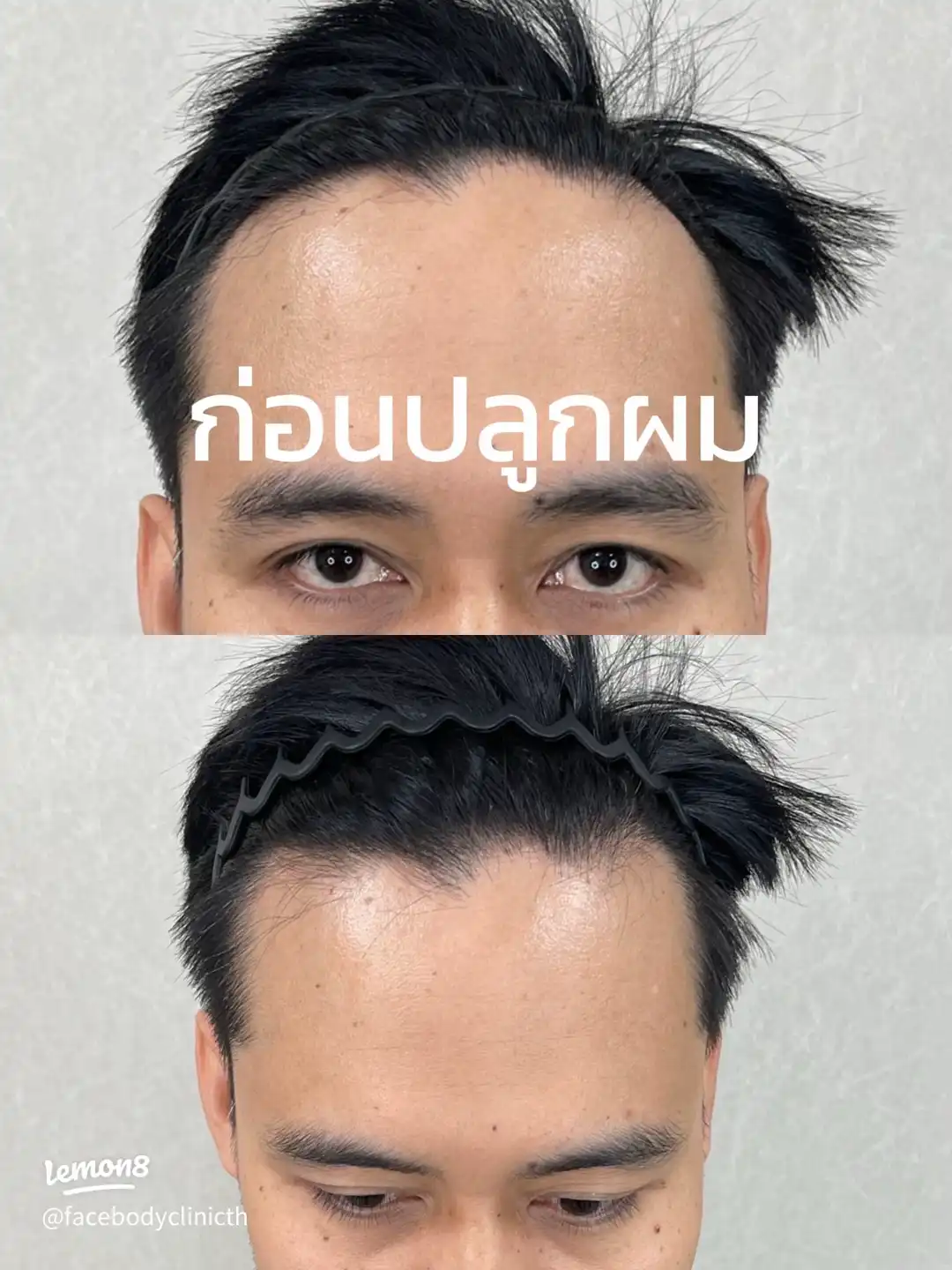 ผมขึ้นหลังปลูกผมครบ 6 เดือน