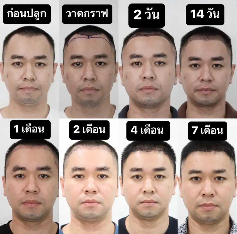 รีวิว FUE ปลูกผม 10 เดือน รีวิว FUE แก้ผมเว้าตัวเอ็มหายขาด