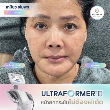REVIEW ULTRAFORMER 3 Facebody (1)