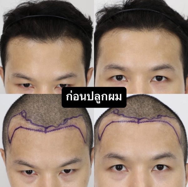 ปลูกผมที่ Facebody